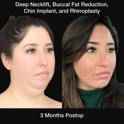Tamplen Plastic Surgery – Buccal Fat Removal.